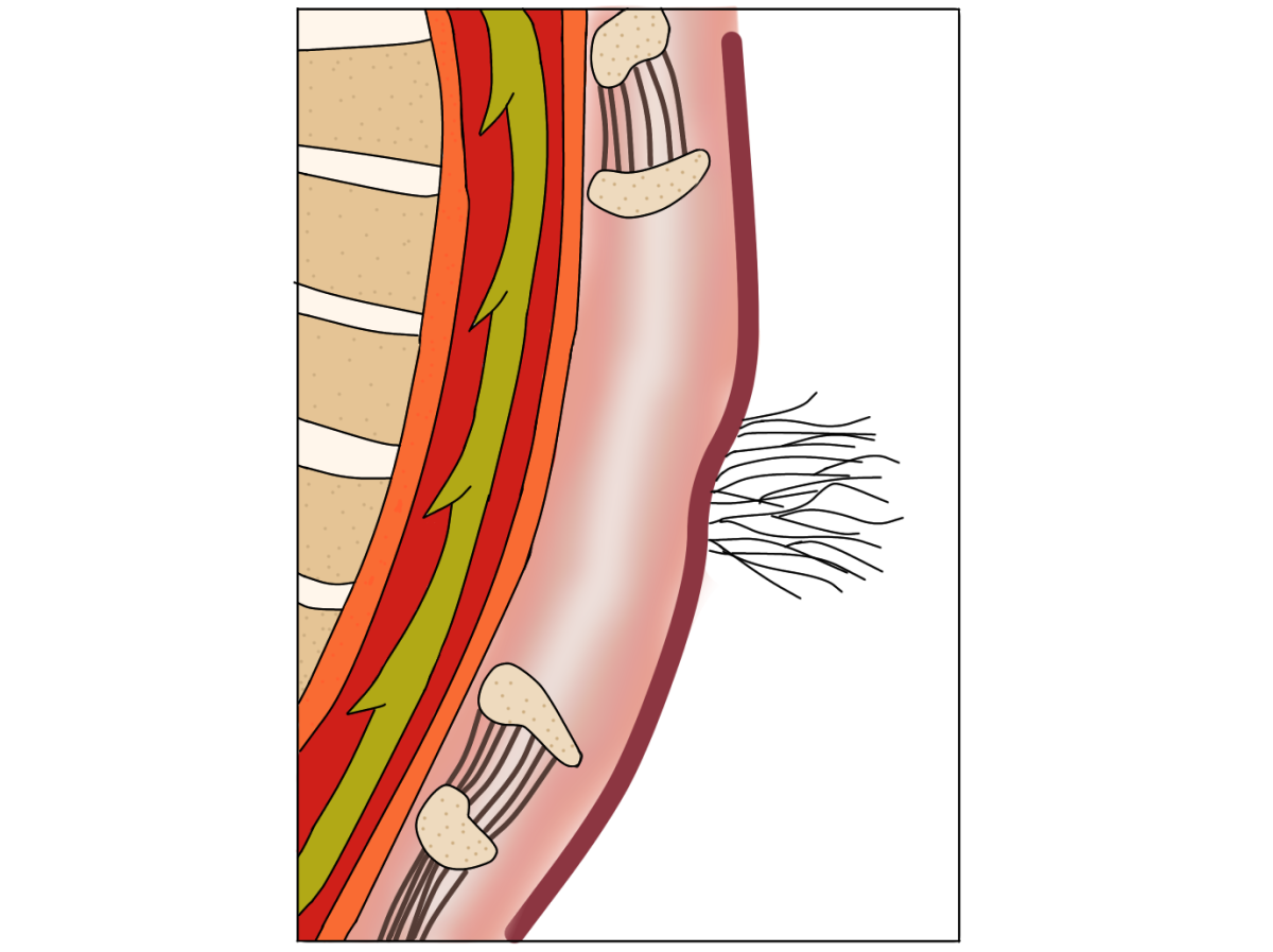 Spina bifida tersembunyi